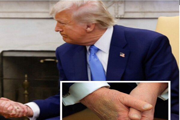 Trump Diagnosed with Chronic Venous Insufficiency